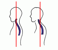 �X�g���[�g�l�b�N�}